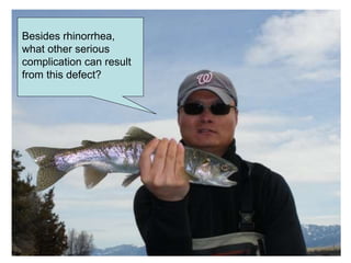 Besides rhinorrhea,
what other serious
complication can result
from this defect?
 