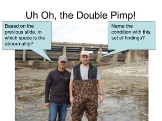 Uh Oh, the Double Pimp!
Name the
condition with this
set of findings?
Based on the
previous slide, in
which space is the
abnormality?
 