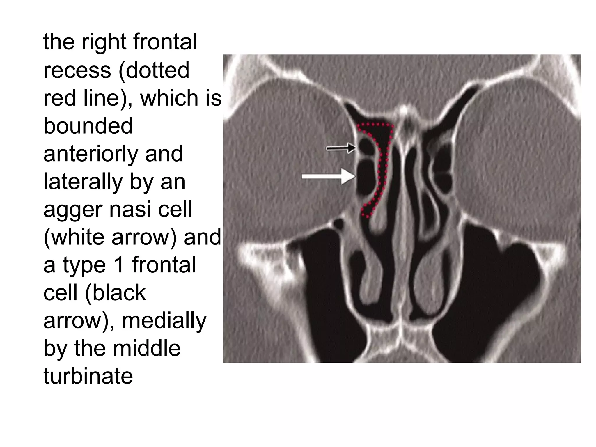 the right frontal
recess (dotted
red line), which is
bounded
anteriorly and
laterally by an
agger nasi cell
(white arrow) and
a type 1 frontal
cell (black
arrow), medially
by the middle
turbinate
 