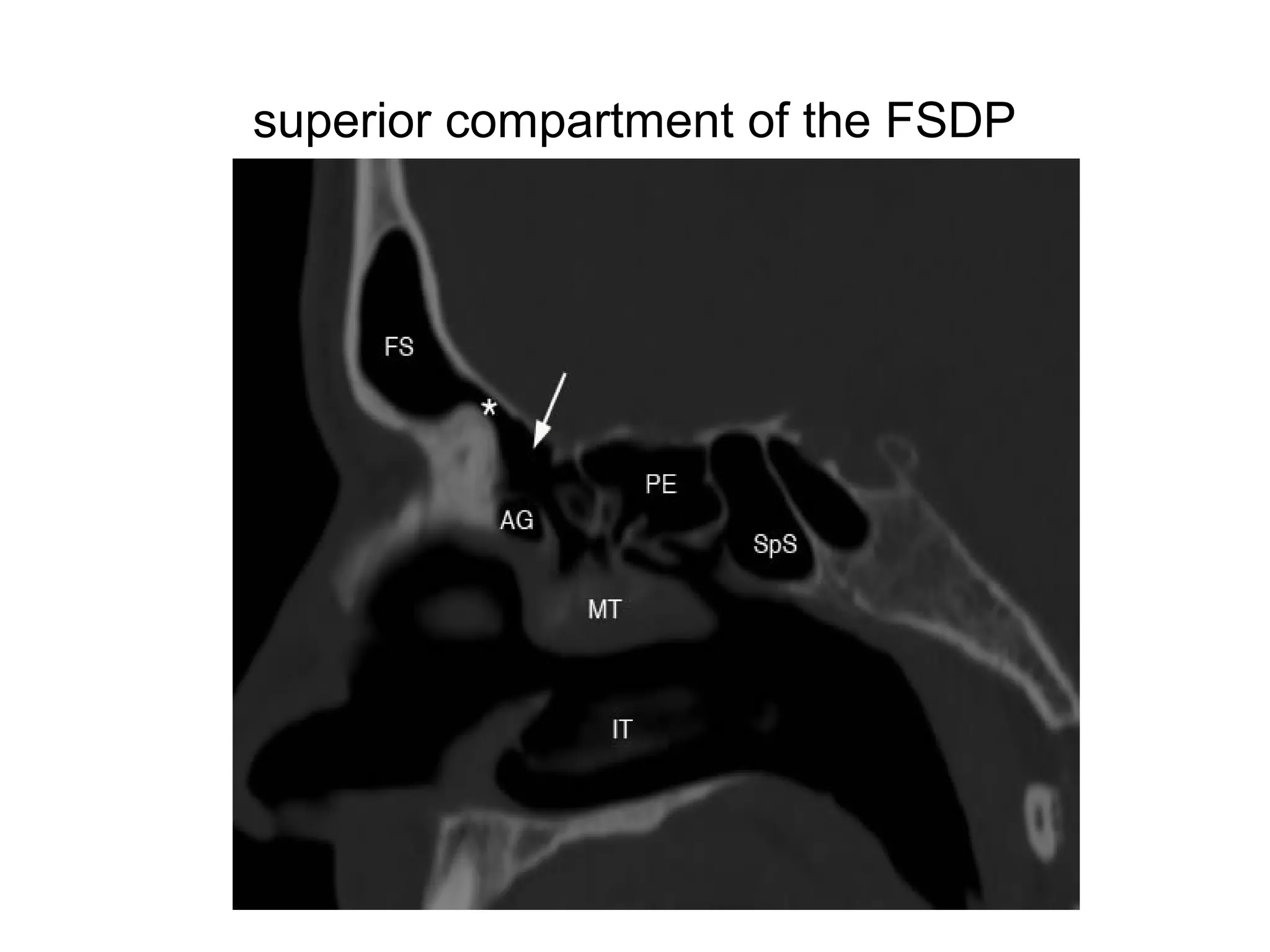 superior compartment of the FSDP
 