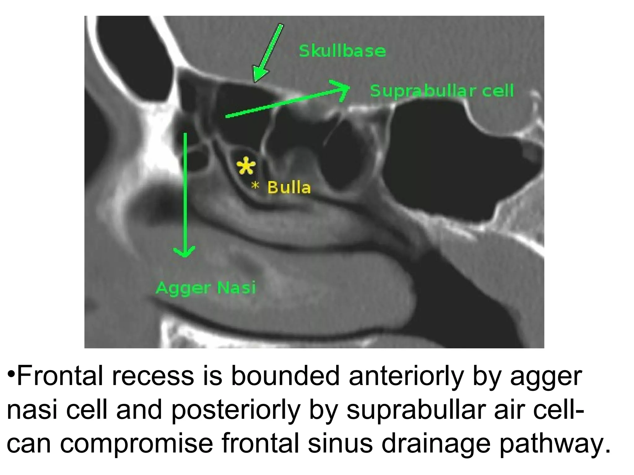 •Frontal recess is bounded anteriorly by agger
nasi cell and posteriorly by suprabullar air cell-
can compromise frontal sinus drainage pathway.
 
