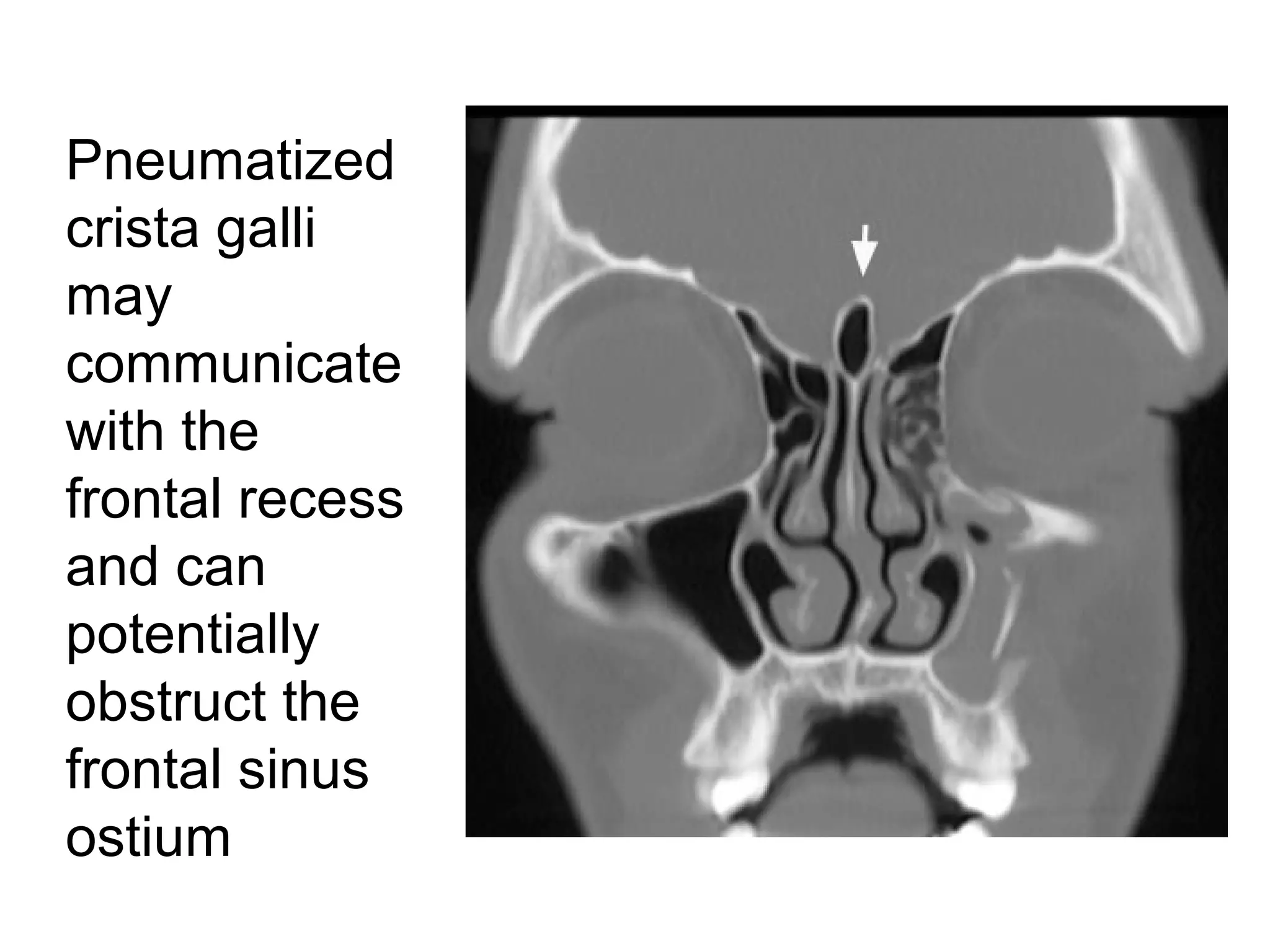 Pneumatized
crista galli
may
communicate
with the
frontal recess
and can
potentially
obstruct the
frontal sinus
ostium
 