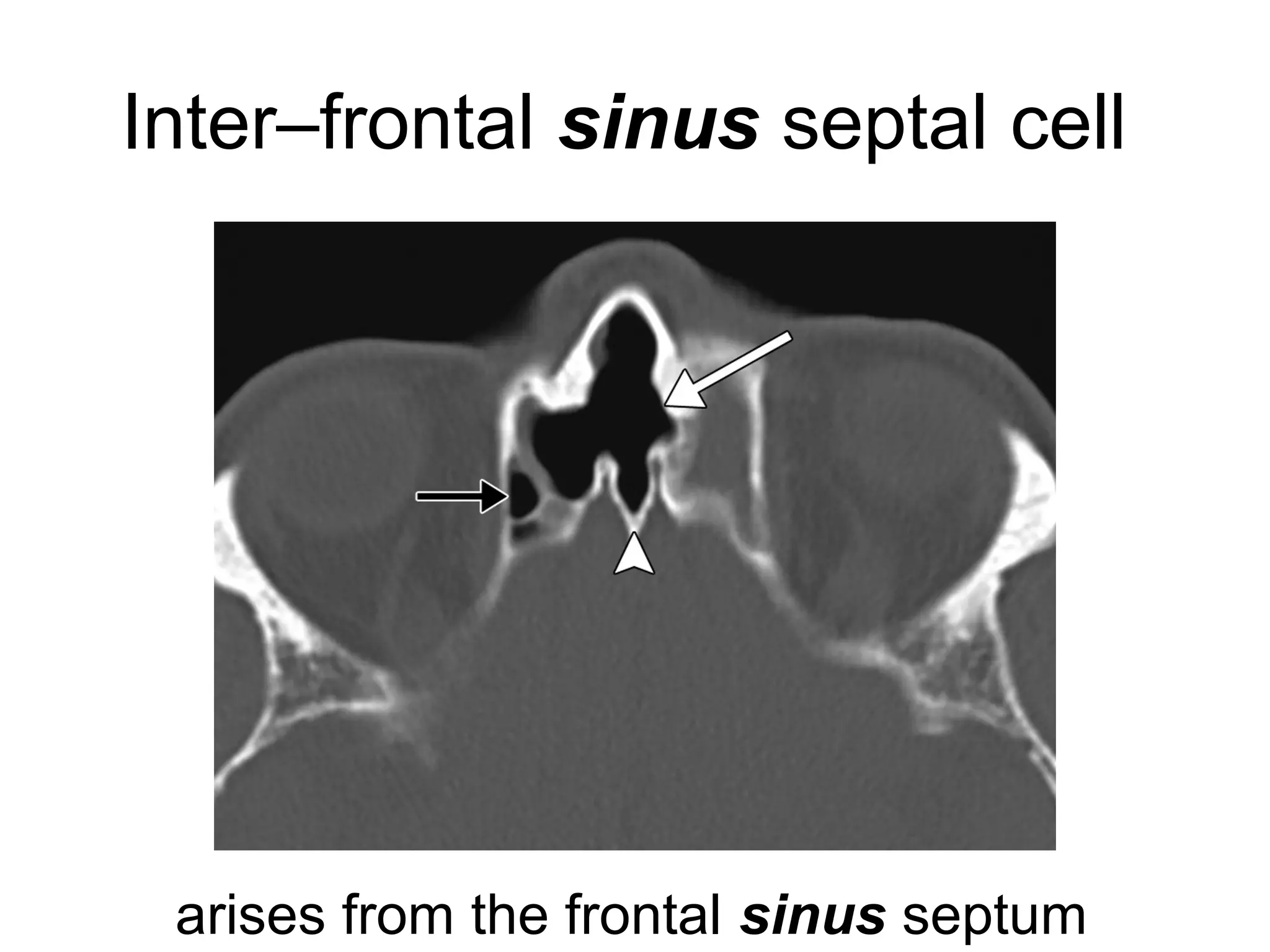 Inter–frontal sinus septal cell
arises from the frontal sinus septum
 
