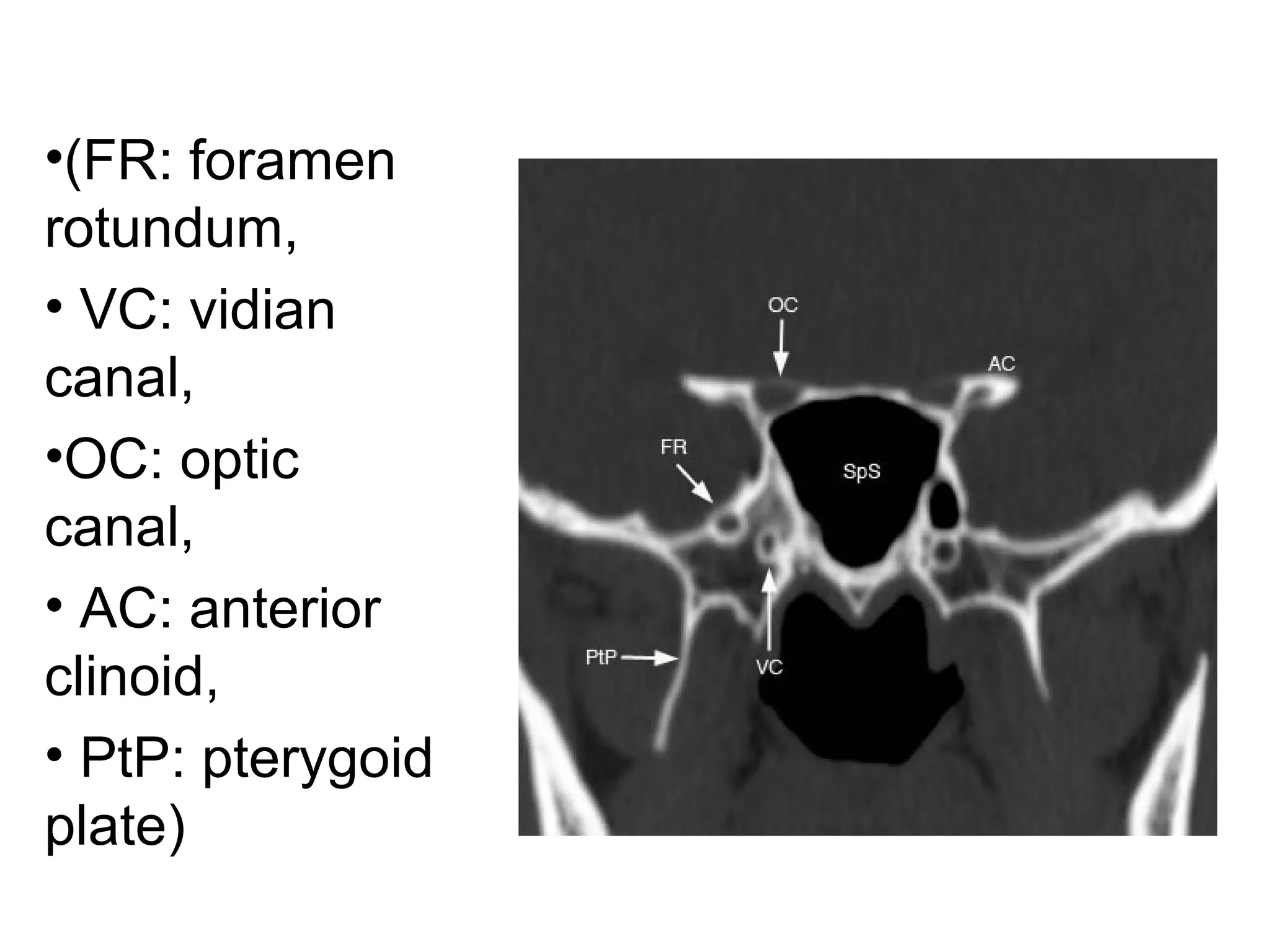 •(FR: foramen
rotundum,
• VC: vidian
canal,
•OC: optic
canal,
• AC: anterior
clinoid,
• PtP: pterygoid
plate)
 