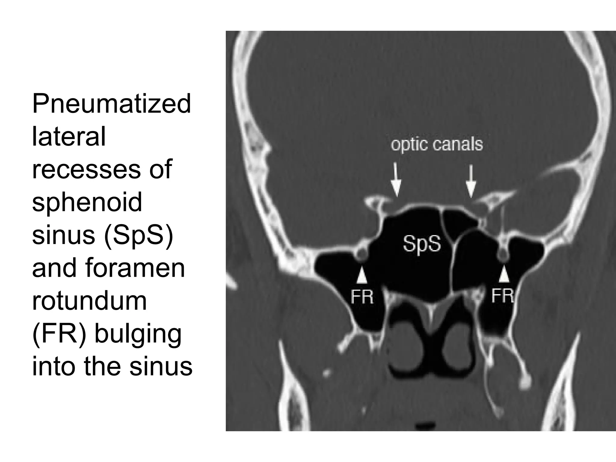 Pneumatized
lateral
recesses of
sphenoid
sinus (SpS)
and foramen
rotundum
(FR) bulging
into the sinus
 