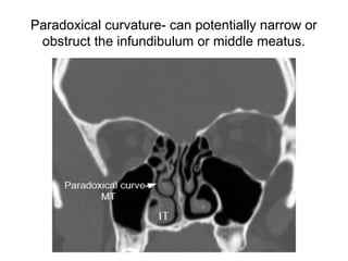Paradoxical curvature- can potentially narrow or
obstruct the infundibulum or middle meatus.
 