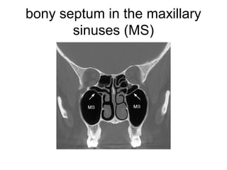 bony septum in the maxillary
sinuses (MS)
 
