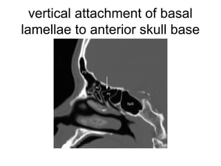 vertical attachment of basal
lamellae to anterior skull base
 