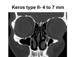 Keros type II- 4 to 7 mm
 