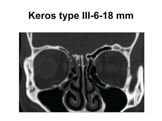 Keros type III-6-18 mm
 