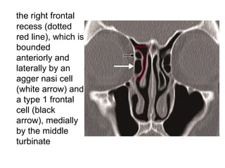 the right frontal
recess (dotted
red line), which is
bounded
anteriorly and
laterally by an
agger nasi cell
(white arrow) and
a type 1 frontal
cell (black
arrow), medially
by the middle
turbinate
 