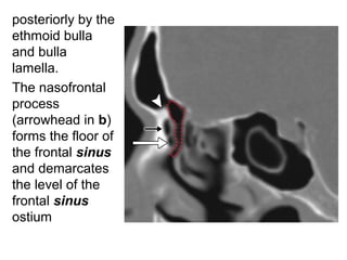   
posteriorly by the
ethmoid bulla
and bulla
lamella.
The nasofrontal
process
(arrowhead in b)
forms the floor of
the frontal sinus
and demarcates
the level of the
frontal sinus
ostium
 