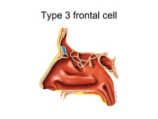 Type 3 frontal cell
 
