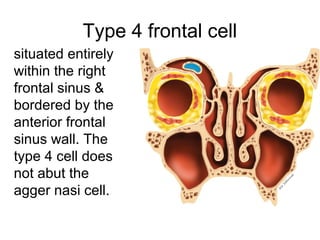 Type 4 frontal cell
situated entirely
within the right
frontal sinus &
bordered by the
anterior frontal
sinus wall. The
type 4 cell does
not abut the
agger nasi cell.
 