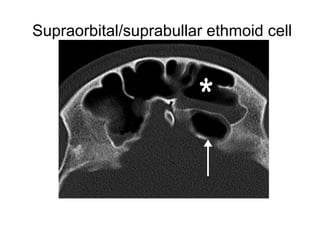 Supraorbital/suprabullar ethmoid cell
 
