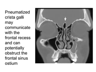 Pneumatized
crista galli
may
communicate
with the
frontal recess
and can
potentially
obstruct the
frontal sinus
ostium
 