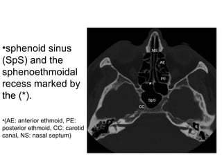 •sphenoid sinus
(SpS) and the
sphenoethmoidal
recess marked by
the (*).
•(AE: anterior ethmoid, PE:
posterior ethmoid, CC: carotid
canal, NS: nasal septum)
 