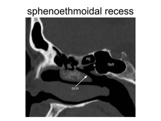 sphenoethmoidal recess
 
