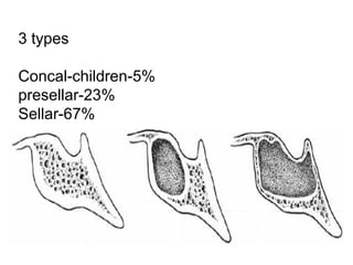 3 types
Concal-children-5%
presellar-23%
Sellar-67%
 
