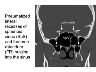 Pneumatized
lateral
recesses of
sphenoid
sinus (SpS)
and foramen
rotundum
(FR) bulging
into the sinus
 