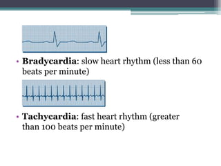 • Bradycardia: slow heart rhythm (less than 60
beats per minute)
• Tachycardia: fast heart rhythm (greater
than 100 beats per minute)
 