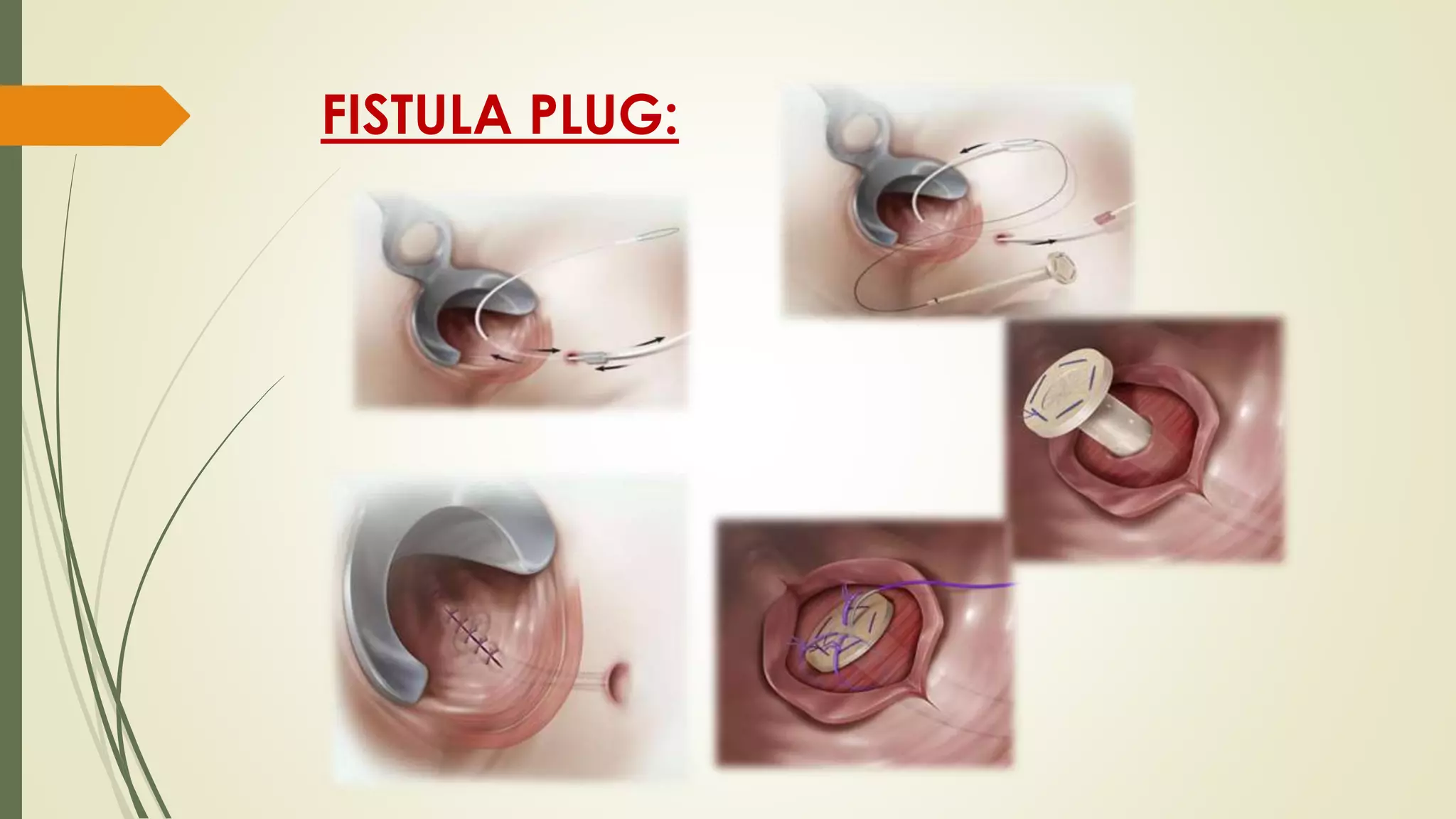 Sinus and fistula | PPTX