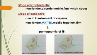 Stage of lymphadentis:
non-tender,discrete,mobile,firm lymph nodes
Stage of peridenitis:
due to involvement of capsule.
non-tender,MATTED,mobile together, firm
pathognomic of TB
 
