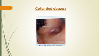 Collar stud abscess
 