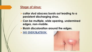 Stage of sinus:
 collar stud abscess bursts out leading to a
persistent discharging sinus.
 Can be multiple, wide opening, undermined
edges, non-mobile.
 Bluish discoloration around the edges.
 NO INDURATION.
 