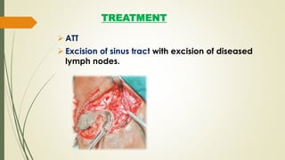 TREATMENT
 ATT
 Excision of sinus tract with excision of diseased
lymph nodes.
 
