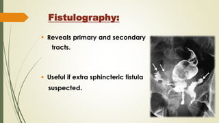 Fistulography:
 Reveals primary and secondary
tracts.
 Useful if extra sphincteric fistula
suspected.
 