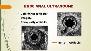 END0 ANAL ULTRASOUND
• Determines sphincter
integrity.
• Complexity of fistula.
horse-shoe fistula
 