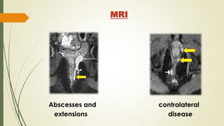 MRI
Abscesses and contralateral
extensions disease
 