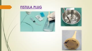 FISTULA PLUG
 