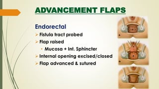 ADVANCEMENT FLAPS
Endorectal
 Fistula tract probed
 Flap raised
• Mucosa + Int. Sphincter
 Internal opening excised/closed
 Flap advanced & sutured
 