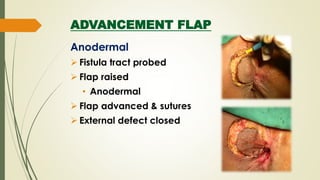 ADVANCEMENT FLAP
Anodermal
 Fistula tract probed
 Flap raised
• Anodermal
 Flap advanced & sutures
 External defect closed
 
