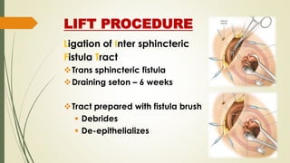 LIFT PROCEDURE
Ligation of Inter sphincteric
Fistula Tract
Trans sphincteric fistula
Draining seton – 6 weeks
Tract prepared with fistula brush
 Debrides
 De-epithelializes
 