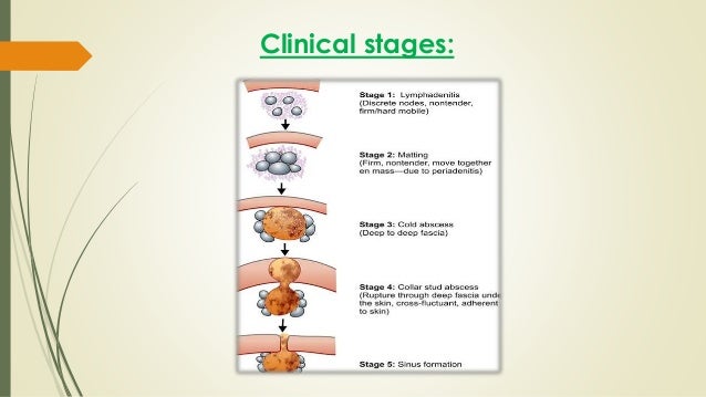 fistula in ano home remedies