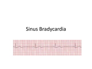 Sinus Bradycardia
 