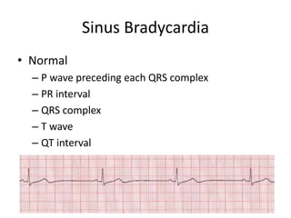 Sinus Bradycardia
• Normal
  – P wave preceding each QRS complex
  – PR interval
  – QRS complex
  – T wave
  – QT interval
 