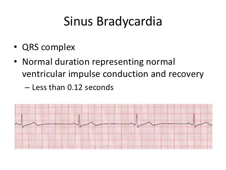 Sinus Bradycardia