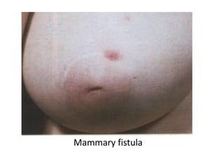 Mammary fistula
 