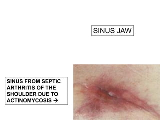 SINUS JAW
SINUS FROM SEPTIC
ARTHRITIS OF THE
SHOULDER DUE TO
ACTINOMYCOSIS 
 