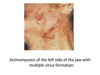 Actinomycosis of the left side of the jaw with
multiple sinus formation.
 