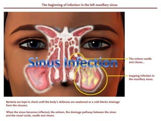 Sinus Infection
 