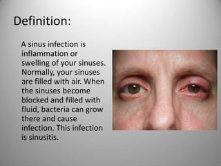 Sinus : définition 