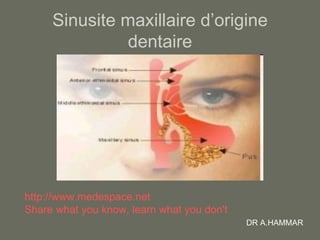 Sinusite maxillaire d’origine dentaire http://www.medespace.net Share what you know, learn what you don't DR A.HAMMAR 
