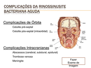 COMPLICAÇÕES DA RINOSSINUSITE
BACTERIANA AGUDA
Complicações de Órbita
Celulite pré-septal
Celulite pós-septal (intraorbital)
Complicações Intracranianas
Abscessos (cerebral, subdural, epidural)
Trombose venosa
Meningite Fazer
Exame de
Imagem
 