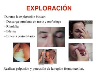 EXPLORACIÓN
Durante la exploración buscar:
- Descarga purulenta en nariz y orofaringe
- Rinolalia
- Edema
- Eritema periorbitario
Realizar palpación y percusión de la región frontomaxilar.
 
