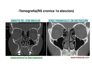 -Tomografía(RS cronica 1a eleccion)
 